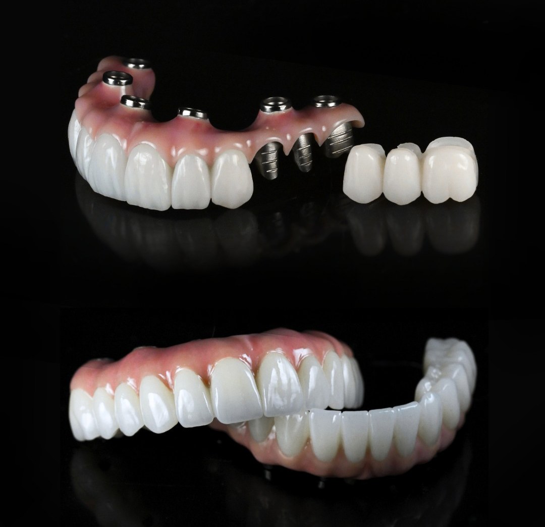 Prótesis de arcada completa All-on-4 y All-on-6 sobre implantes de titanio