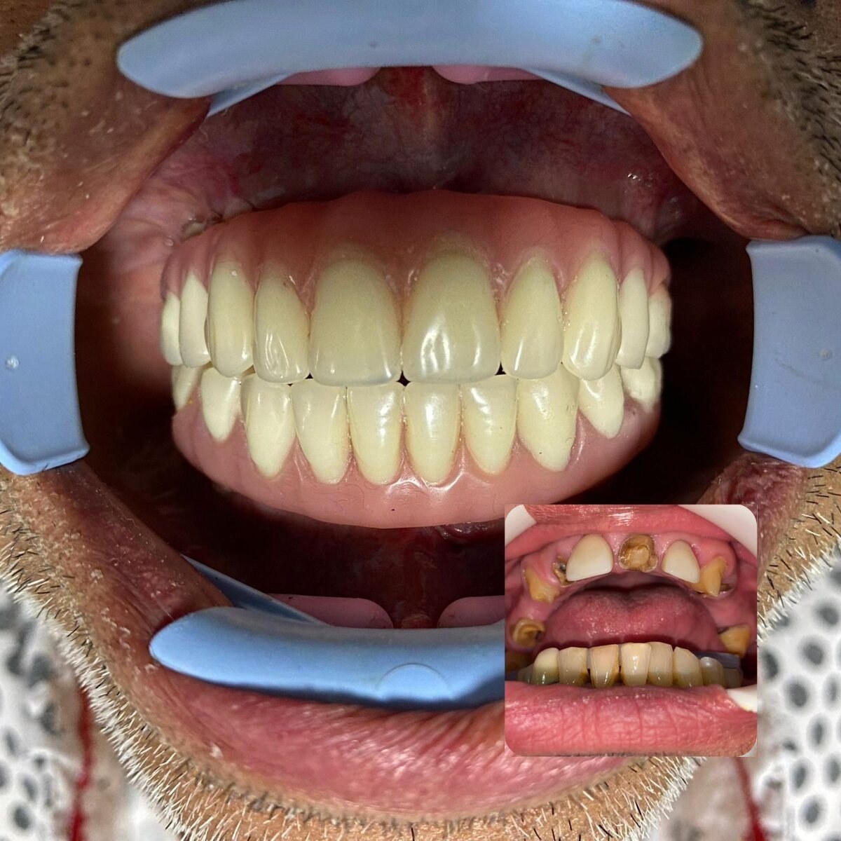 All-on-4 – dientes desgastados y dañados reemplazados
