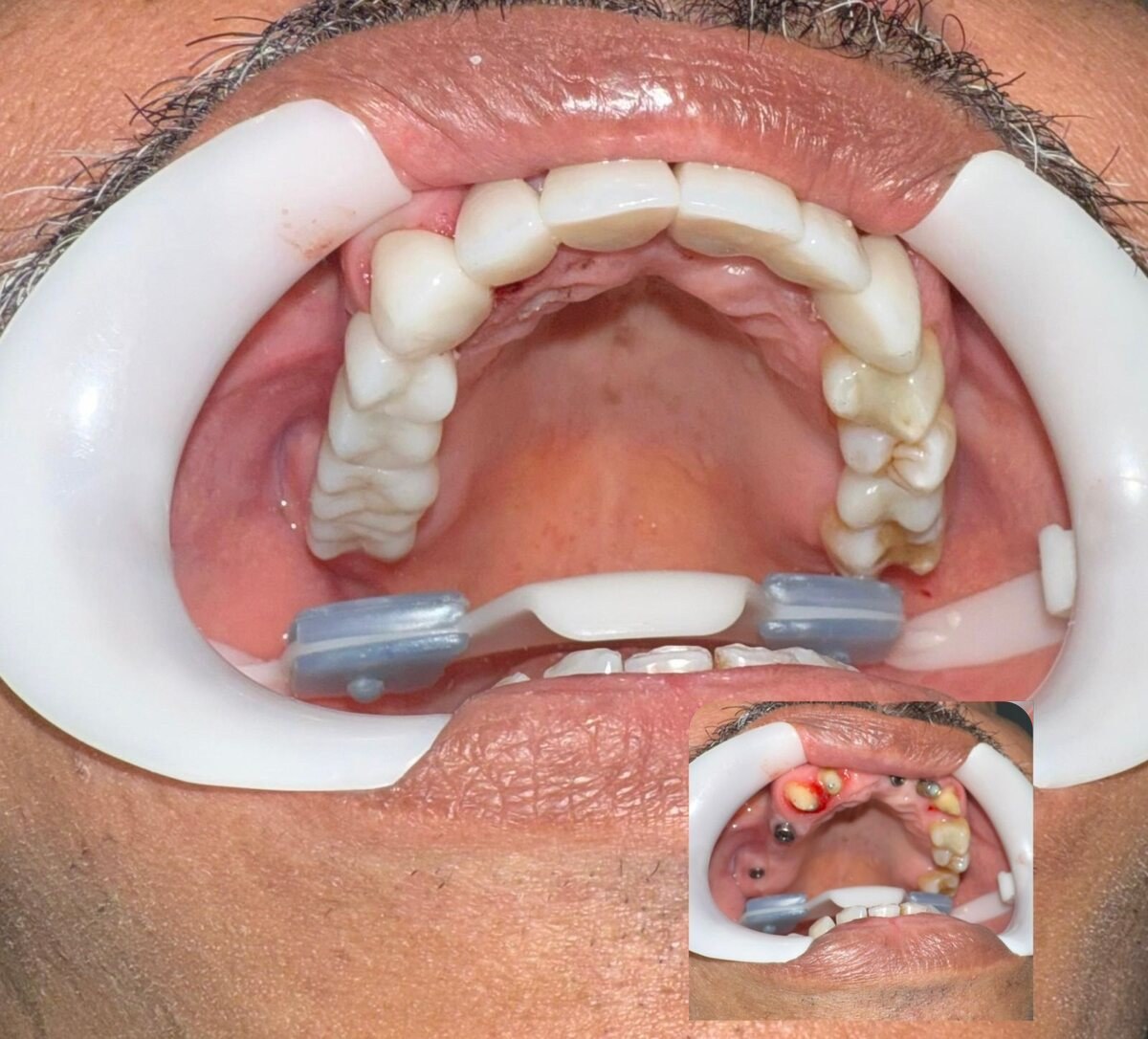 Rehabilitación oral completa