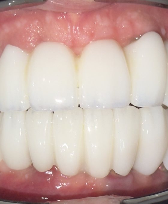 Después del tratamiento de arcada completa con implantes