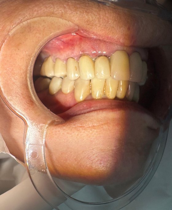 Antes del tratamiento de arcada completa con implantes