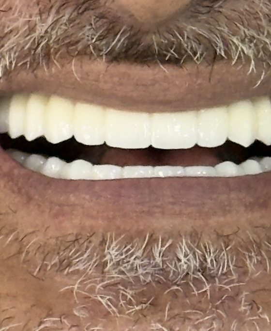 Después del tratamiento de arcada completa con implantes