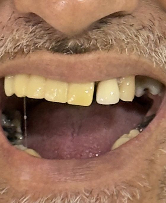 Antes del tratamiento de arcada completa con implantes