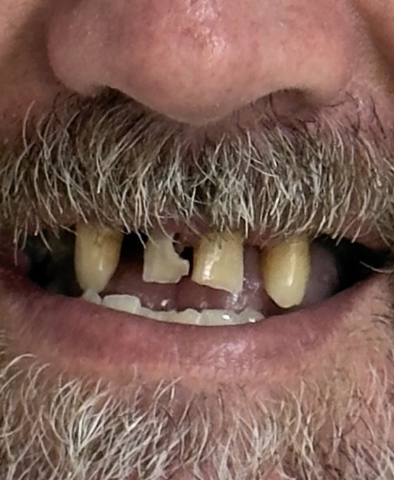 Antes del tratamiento de arcada completa con implantes