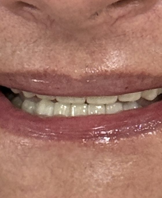 Después del tratamiento de arcada completa con implantes