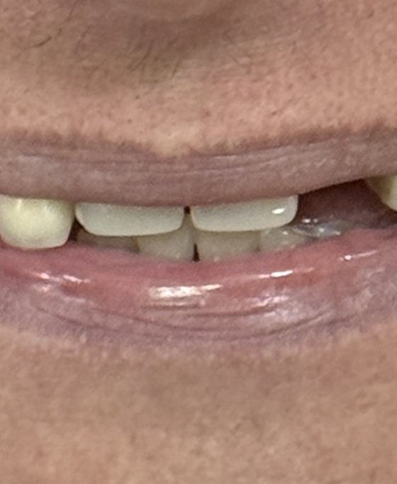 Antes del tratamiento de arcada completa con implantes