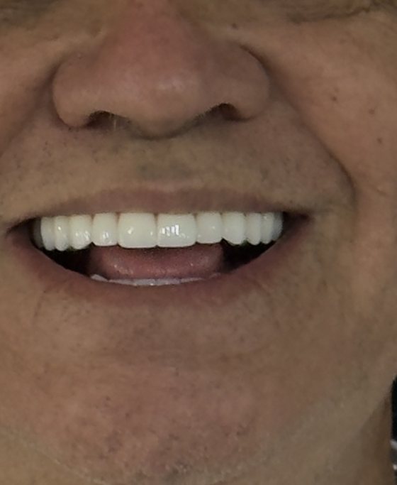 Después del tratamiento de arcada completa con implantes