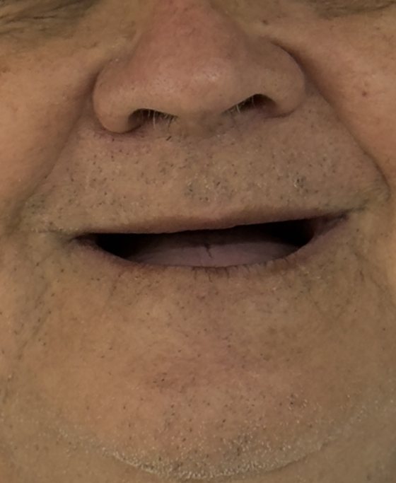 Antes del tratamiento de arcada completa con implantes