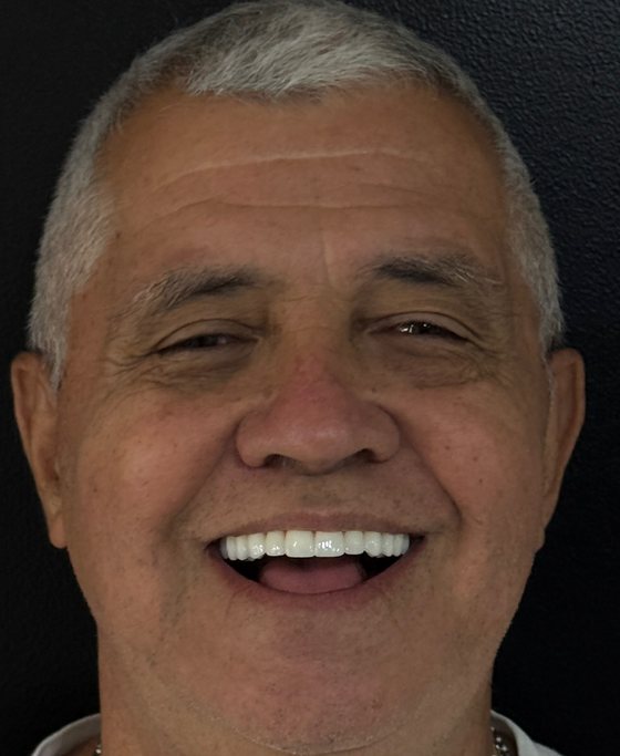 Paciente del Dr. Erick Rivera después del tratamiento de arcada completa