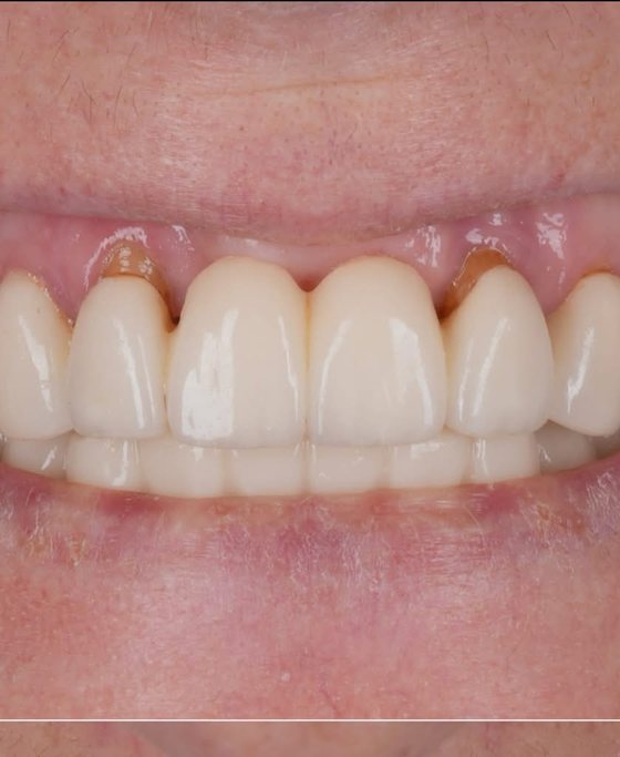 Antes del tratamiento de arcada completa con implantes