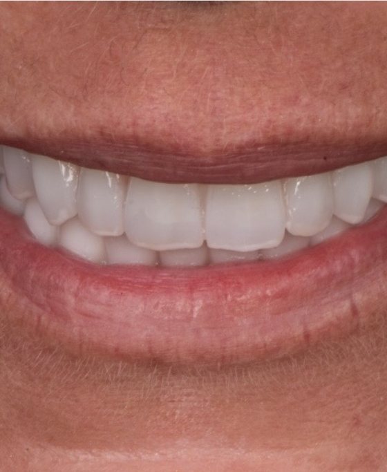 Después del tratamiento de arcada completa con implantes