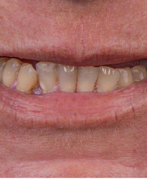 Antes del tratamiento de arcada completa con implantes
