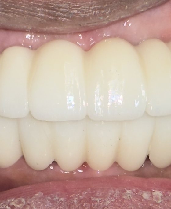 Después del tratamiento de arcada completa con implantes