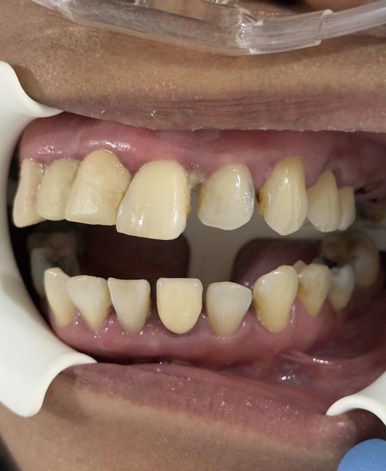 Antes del tratamiento de arcada completa con implantes